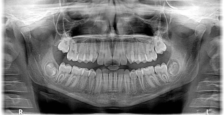 xray x ray 2764828 1280
