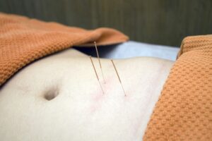 akupunktur behandlung