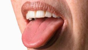 Nährstoffmangel auf der Zunge erkennen